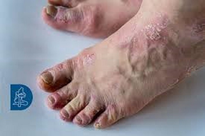 Scopri di più sull'articolo Psoriasi, a Merano un ambulatorio specializzato nella cura di questa malattia